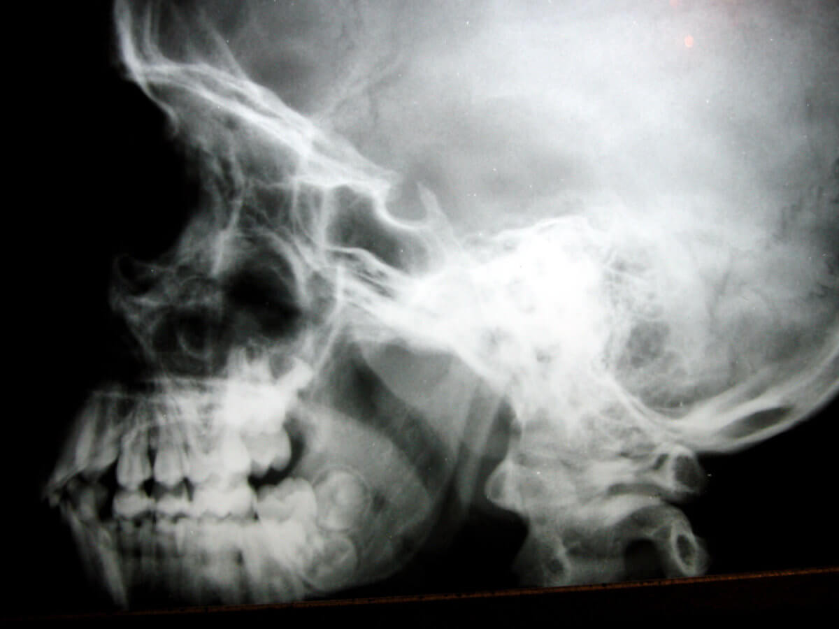 death by asphyxiation