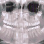 Dental xray