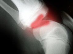 ‘No one likes surprises’: Multiple Injury Trust Fund director replaced as solution sought Multiple Injury Trust Fund