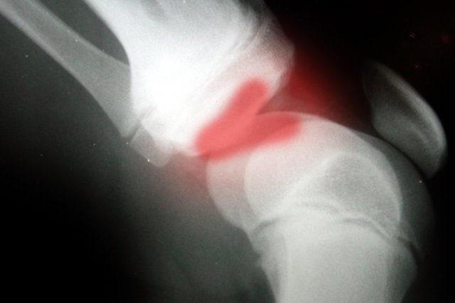 Multiple Injury Trust Fund